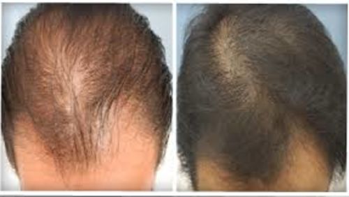 cellule staminali per ricrescita capelli