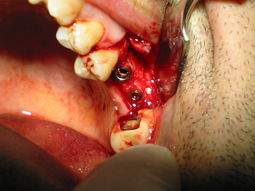 IMPIANTI NEL MASCELLARE SUPERIORE CON SINUS LIFT (...